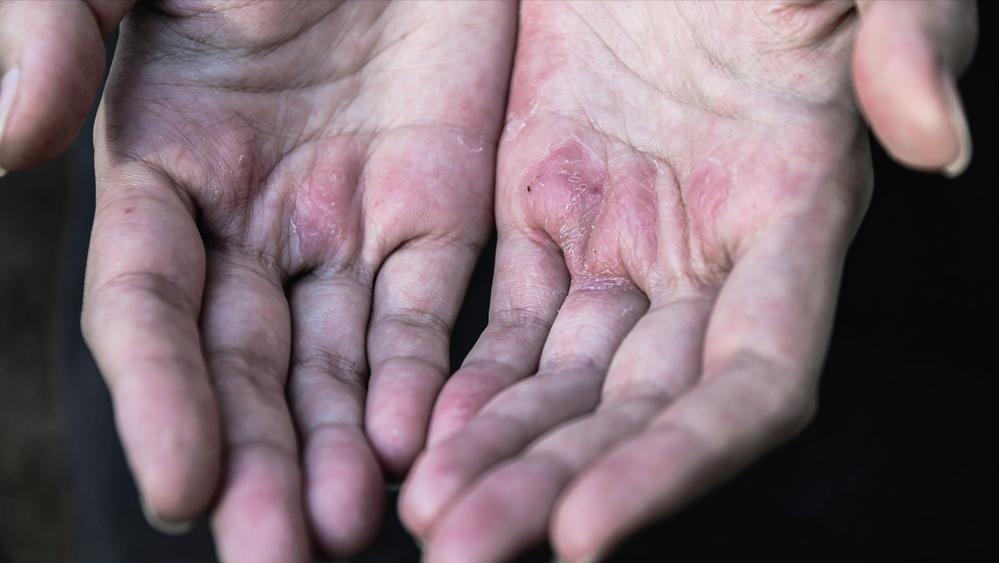 头皮总是长疙瘩或脓包是什么原因,头皮起脓包疙瘩是怎么回事