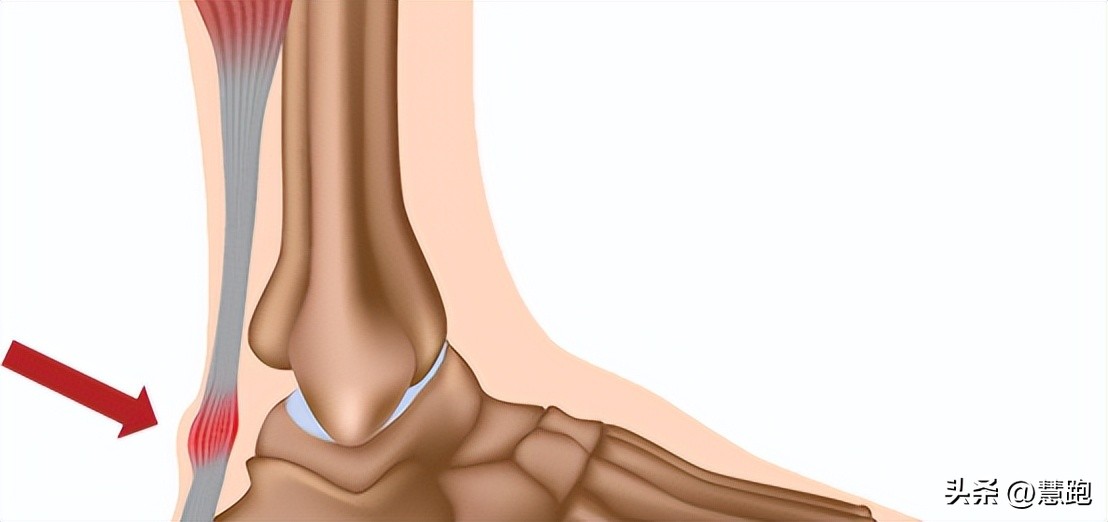 跑步减少受伤的5个方法,跑步六大伤痛解决方案