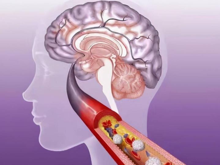 血液粘稠手麻该多注意什么,手麻平时应注意些什么