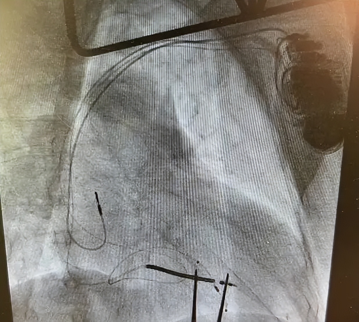 43岁心衰患者植入人工心脏,85岁老人心衰可以植入人工心脏吗