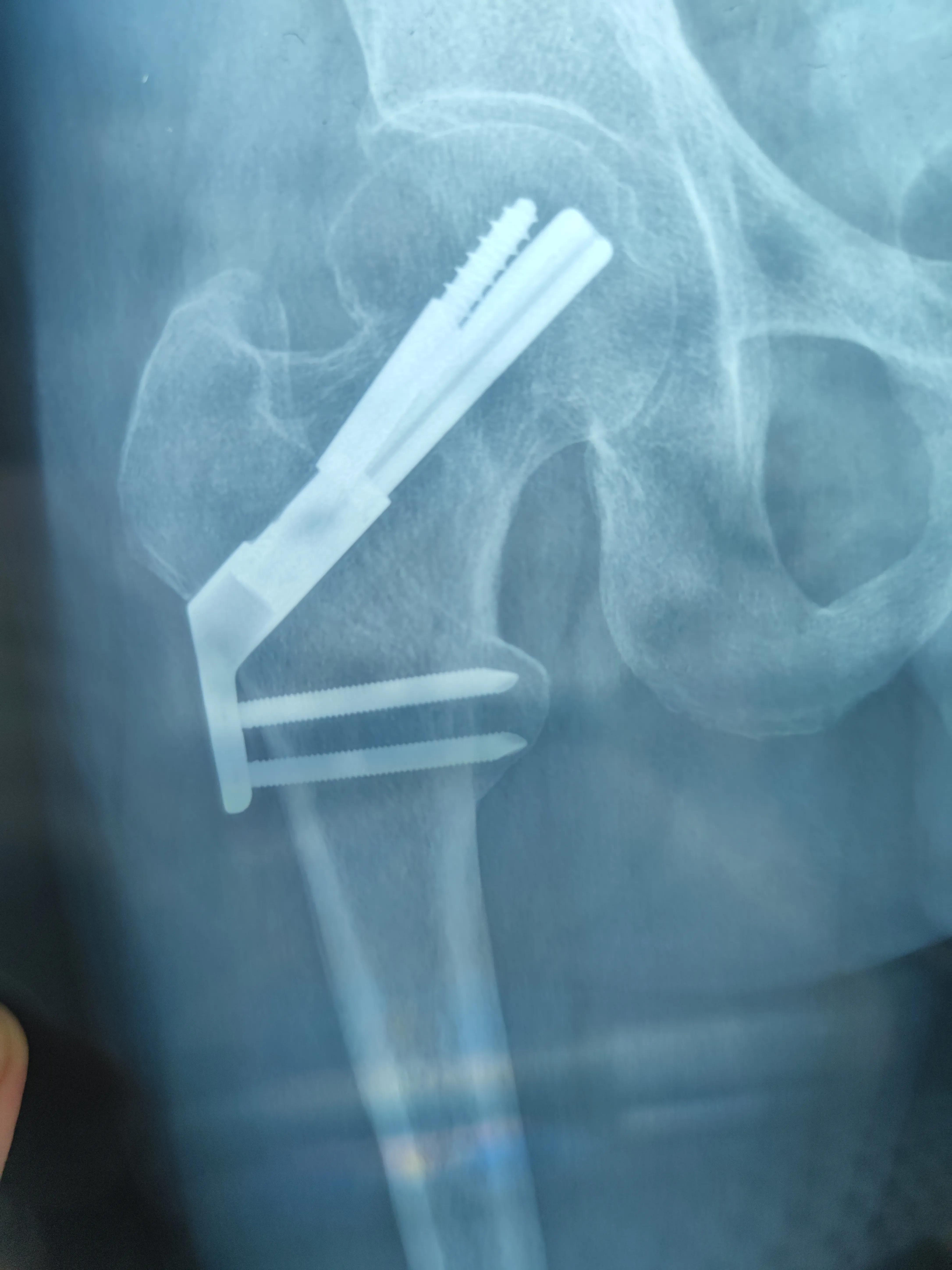 股骨颈骨折康复治疗,股骨颈骨折内固定康复