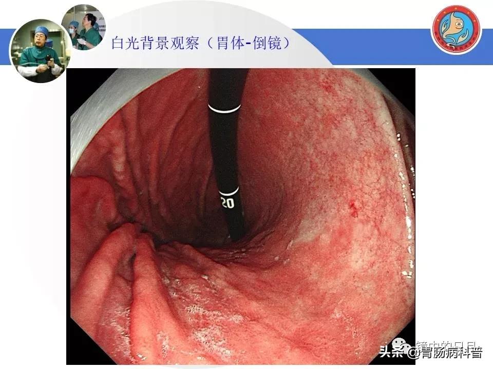 胃癌可以做内镜手术吗,早期胃癌内镜手术后追加外科手术