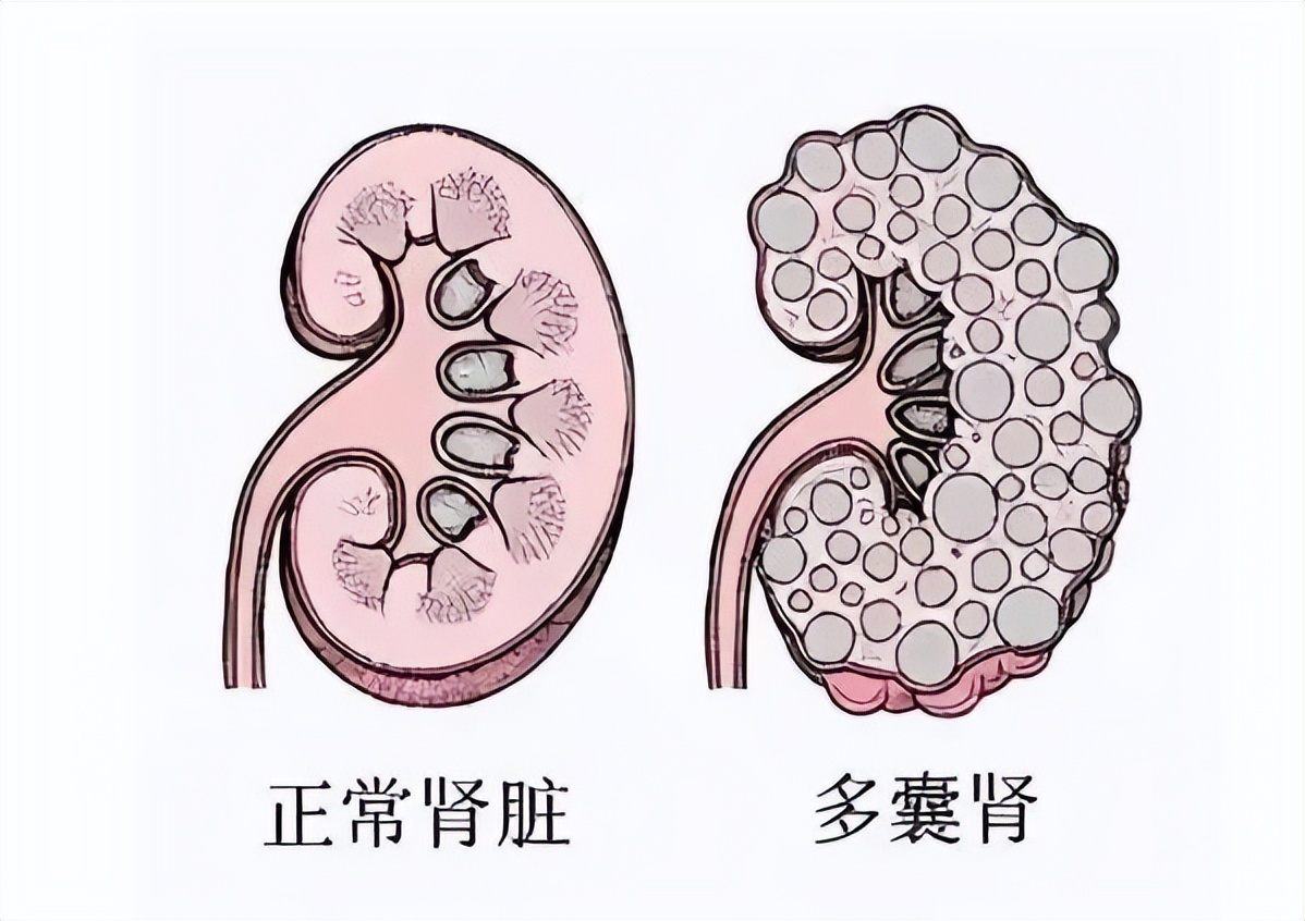 体检查出有肾囊肿和肝囊肿怎么办,体检时肾囊肿单位是毫米还是厘米