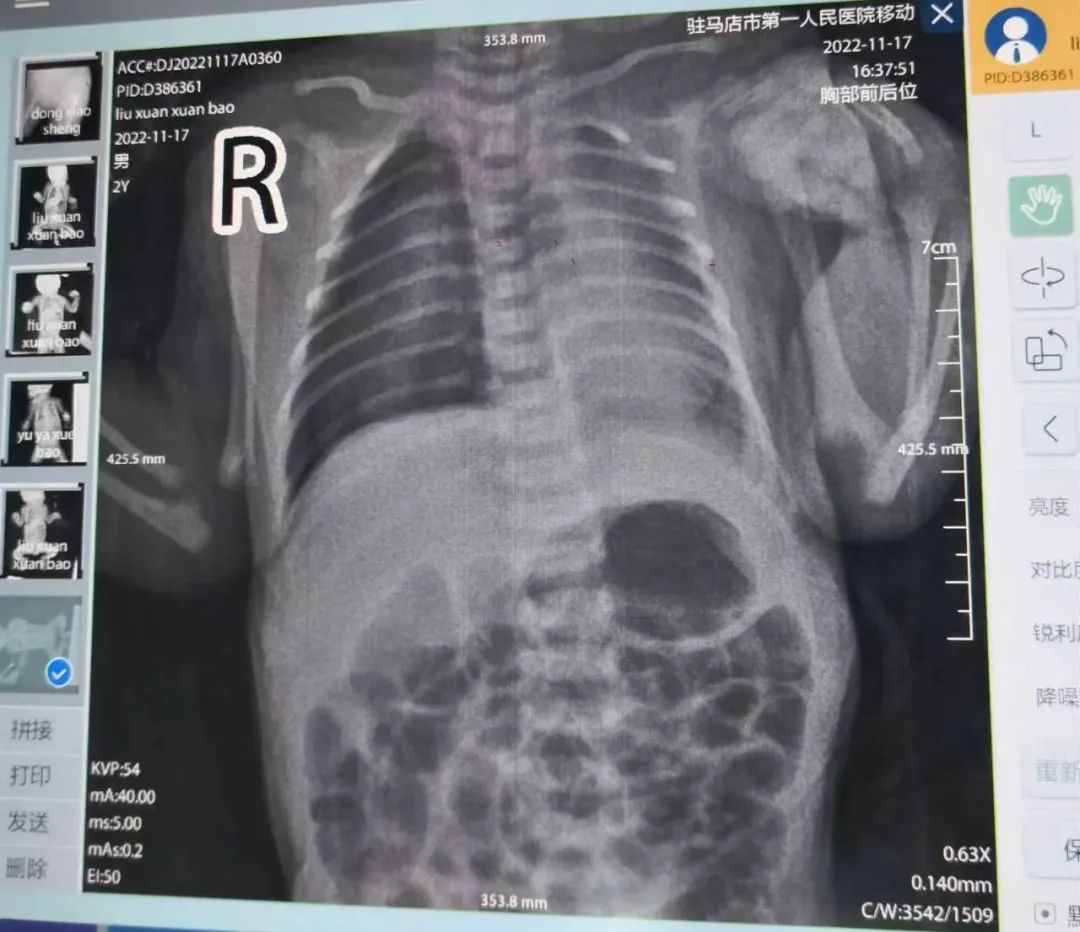 新生儿气胸抢救流程图,新生儿气胸病危