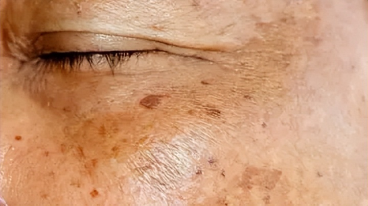 老年斑和色素沉着怎么治,老年人色素沉着怎么去除