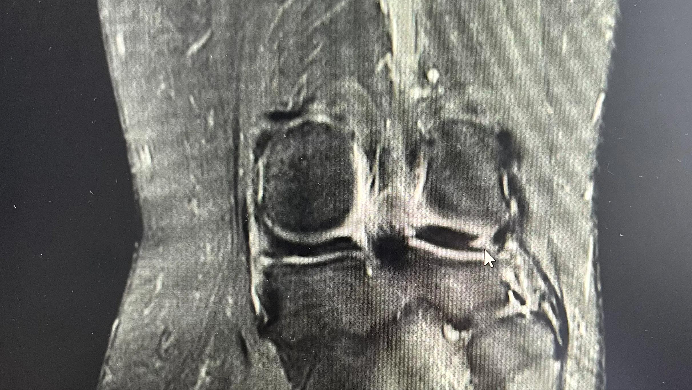 半月板的轻微损伤要注意什么,半月板损伤两年多了最好的方法