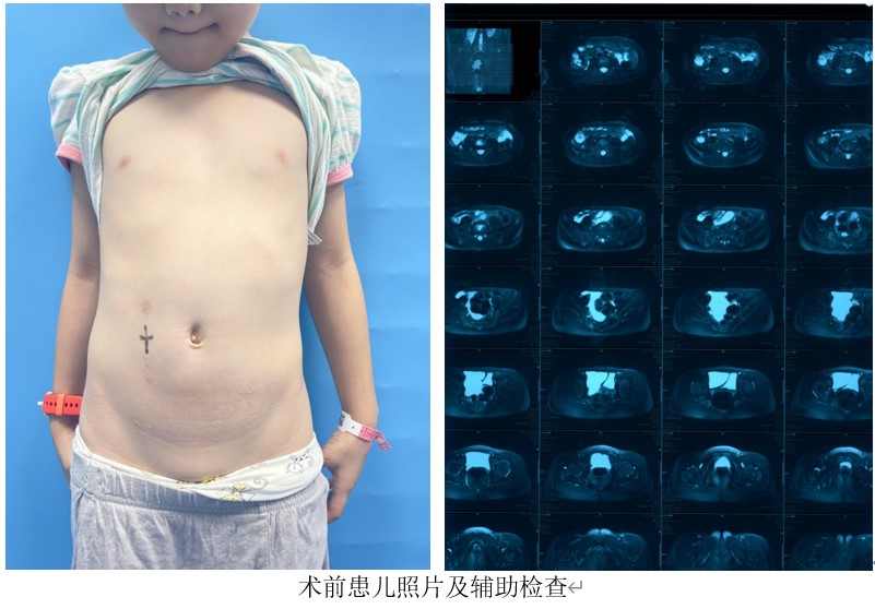 儿童腹腔淋巴管瘤介入微创治疗病例