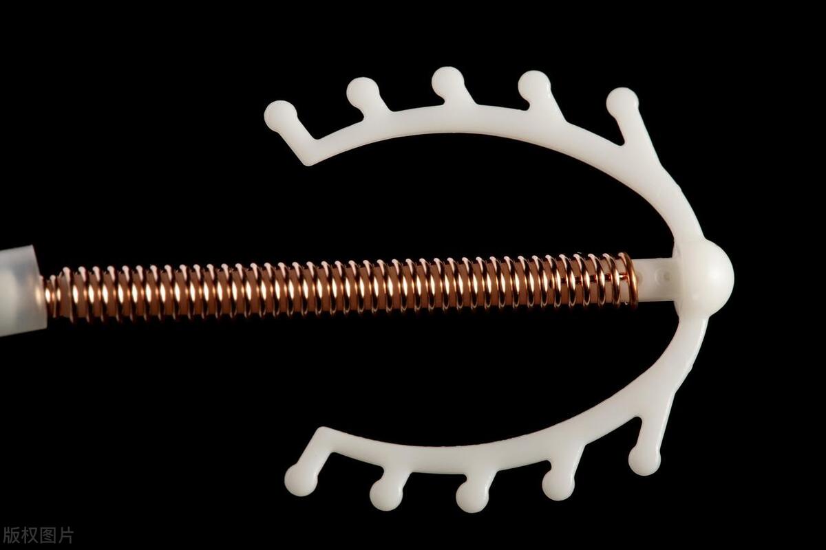 和丈夫同房后下身出血和巨痛，竟是十几年前上的节育环穿透子宫