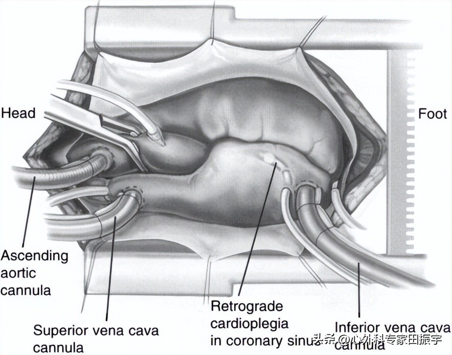 二尖瓣成形术要多少钱,二尖瓣成形术后抗凝多久