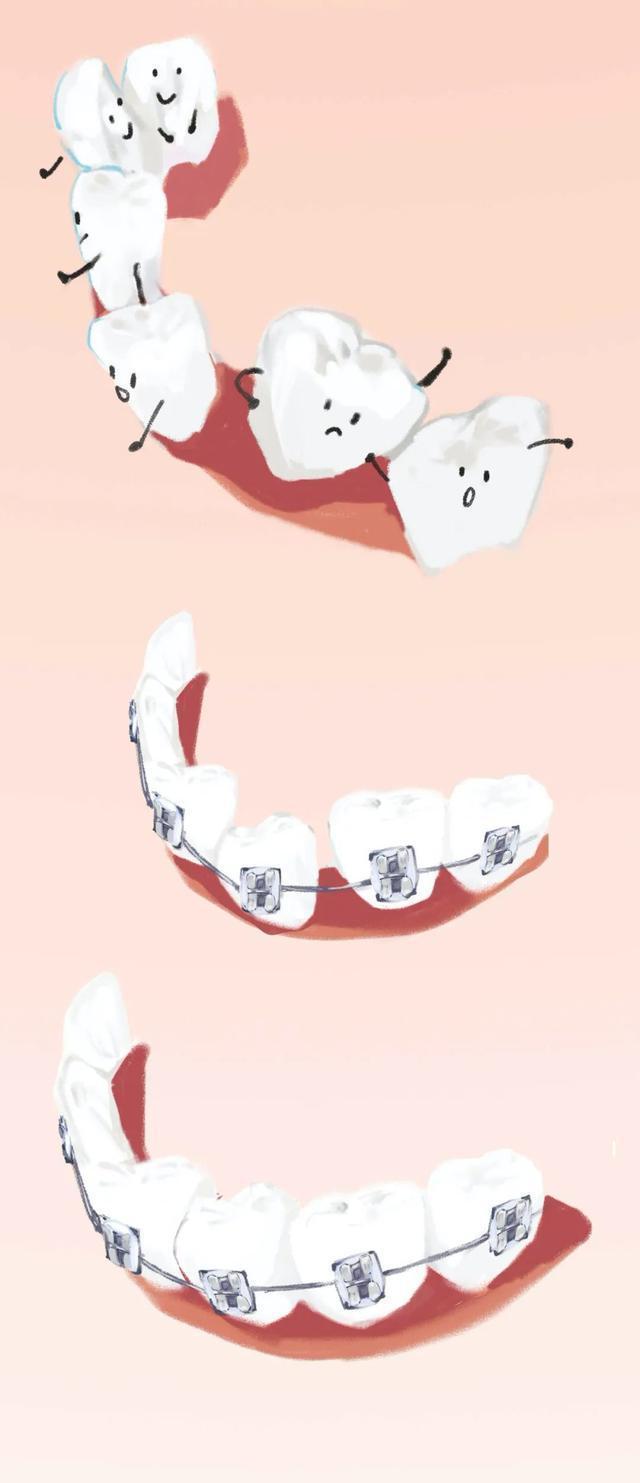 牙套矫正过程漫画,戴牙套是什么体验