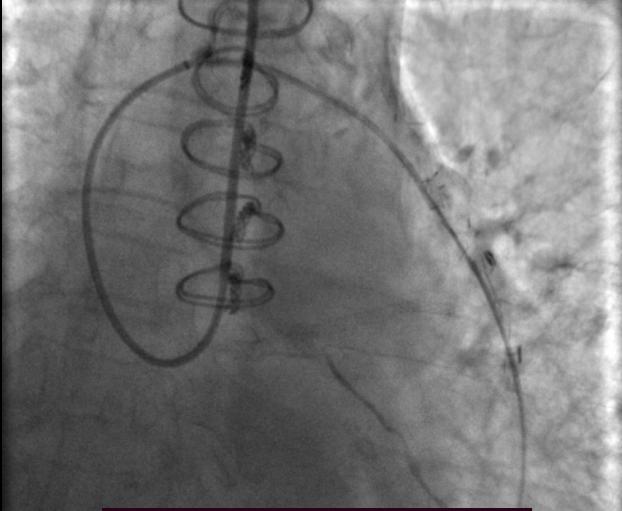 无创血管搭桥手术的全过程,血管闭塞介入手术指征