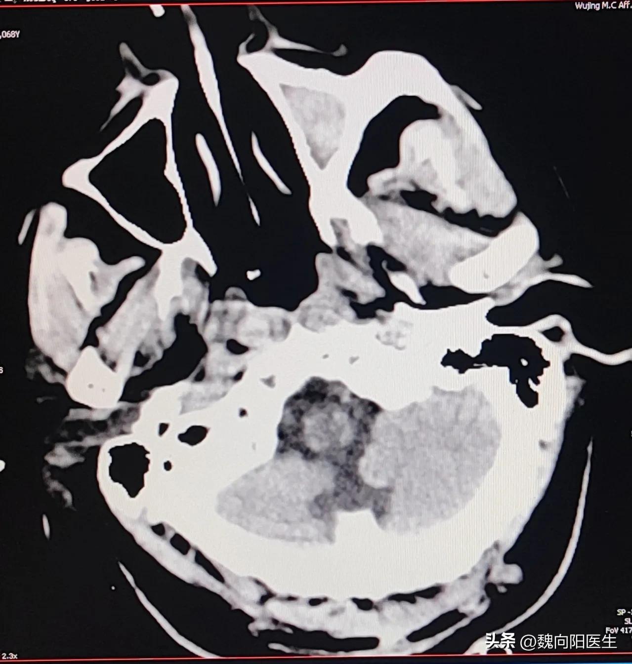 我的老父亲中风病危,我的父亲得了脑梗十九年