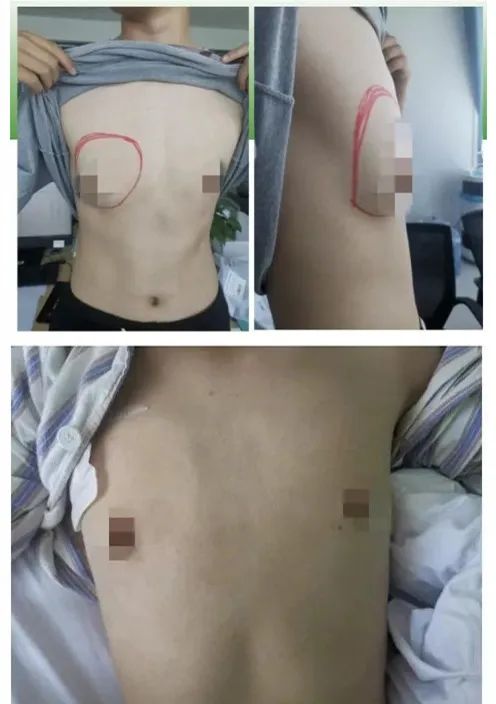 上海治疗男性乳房发育医院,高新区安泰医院