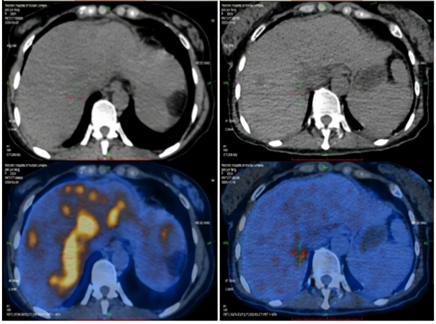 病例实录|免疫联合方案治疗胰腺癌多发转移的病例分享