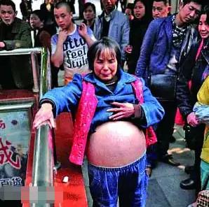 重庆一妇女肚子巨大,女子肚大如球竟是5颗肿瘤