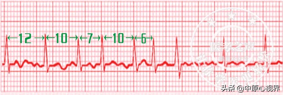 护考几种常见的心电图,常见的心电图图形分析