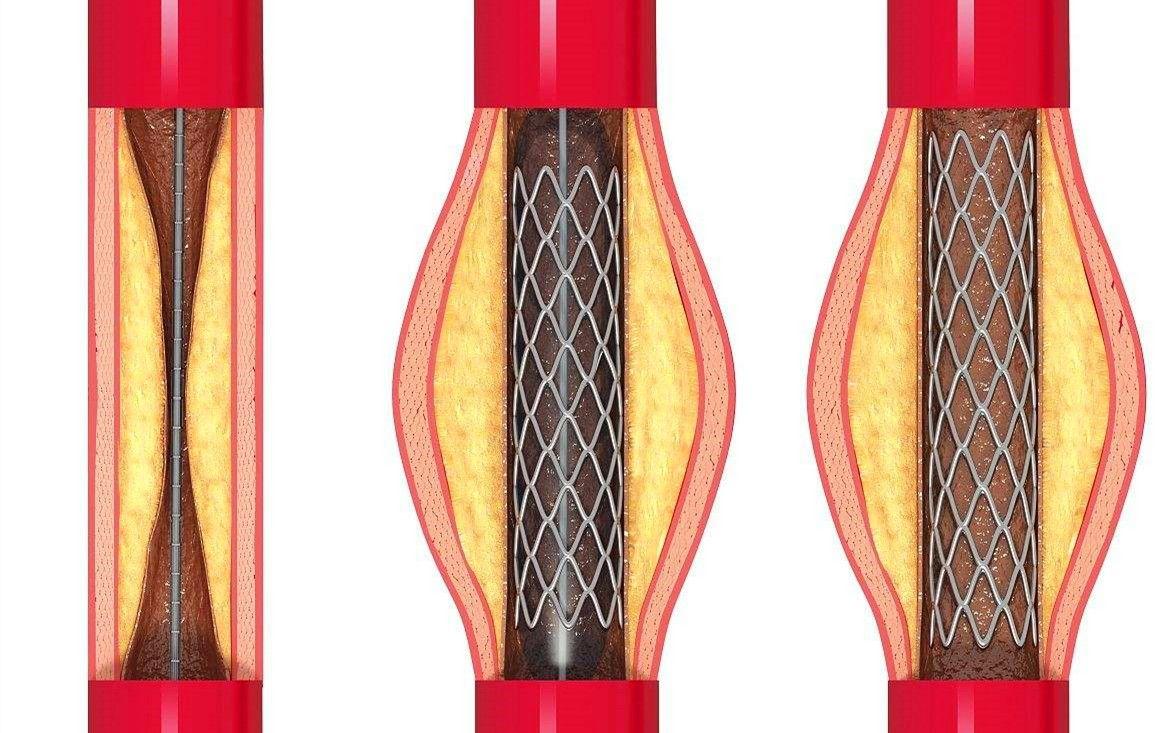 700块的心脏支架和20000块的药物球囊，哪个更好？医生：别误解了