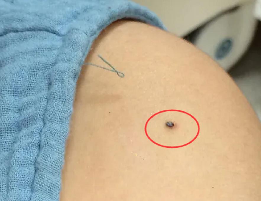 蜱虫会整个钻入身体吗,吸血蜱虫究竟有多可怕