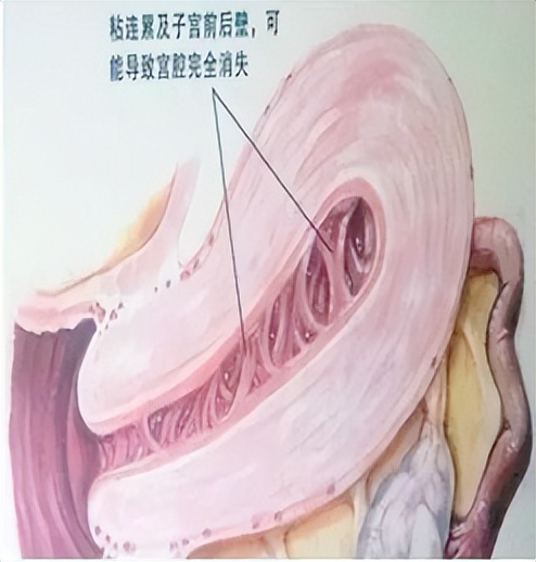 无痛人流术后多久来大姨妈,人流术后来了两次大姨妈就不来了