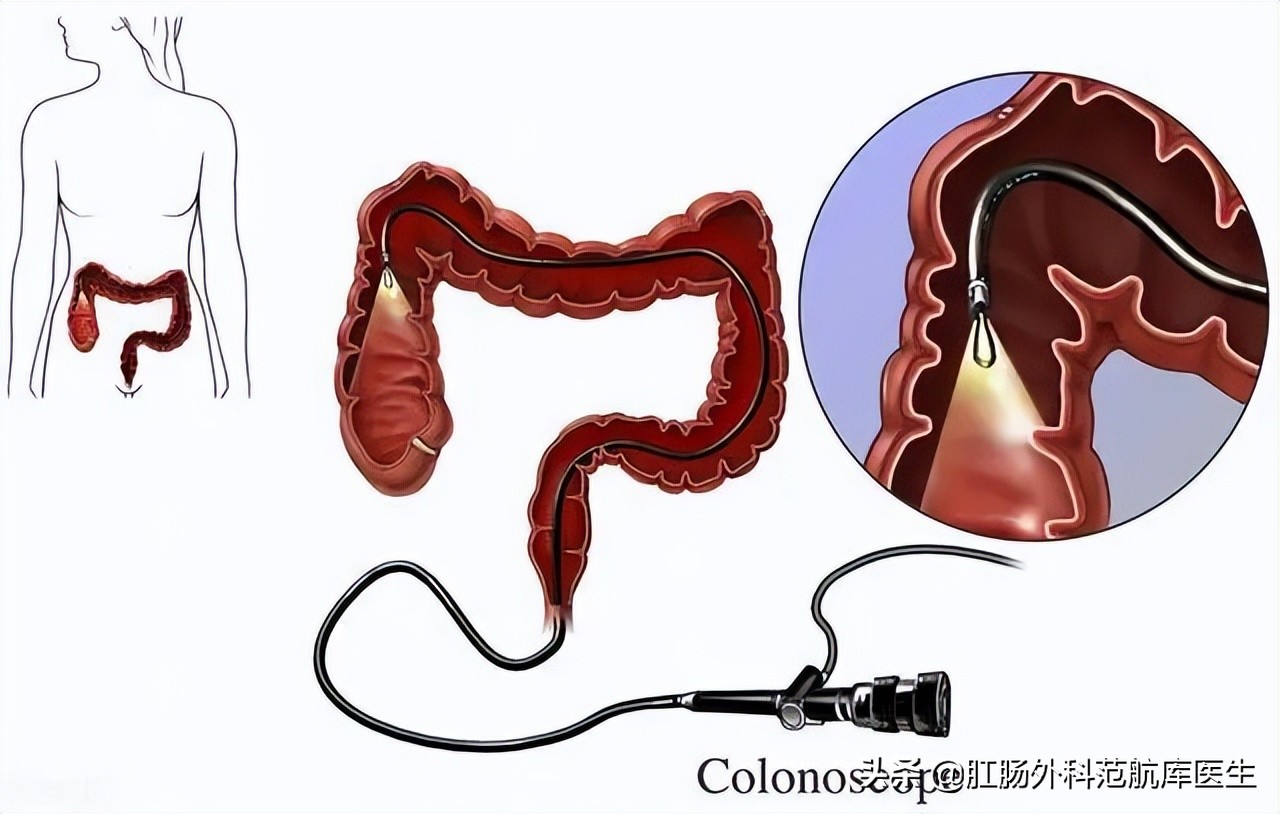 肛门镜和肠镜的区别
