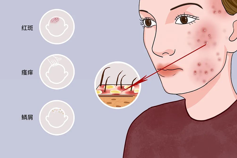 鼻子脂溢性皮炎涂什么药膏,脂溢性皮炎最简单自愈方法