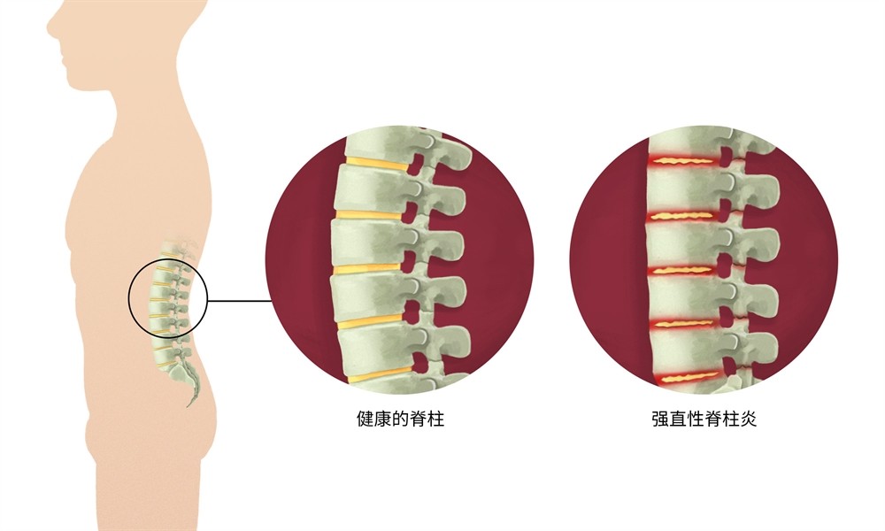 治疗强直性脊柱炎必须按体质治吗,针对强直性脊柱炎最好的锻炼方法