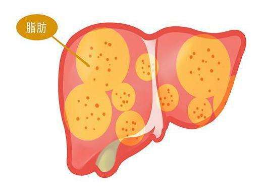 脂肪肝需不需要药物治疗,脂肪肝要不要紧