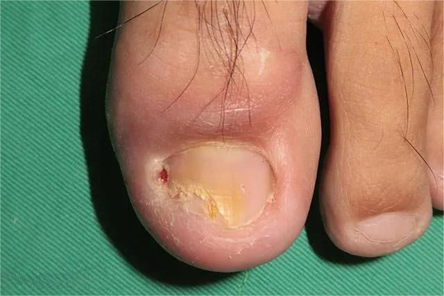 甲癣不严重怎么治疗,甲易生治疗灰指甲吗