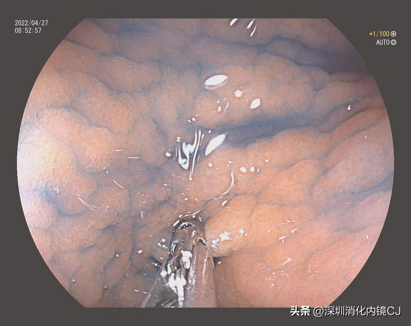 幽门螺旋杆菌感染胃粘膜表现,没有幽门杆菌但是胃窦鸡皮样改变