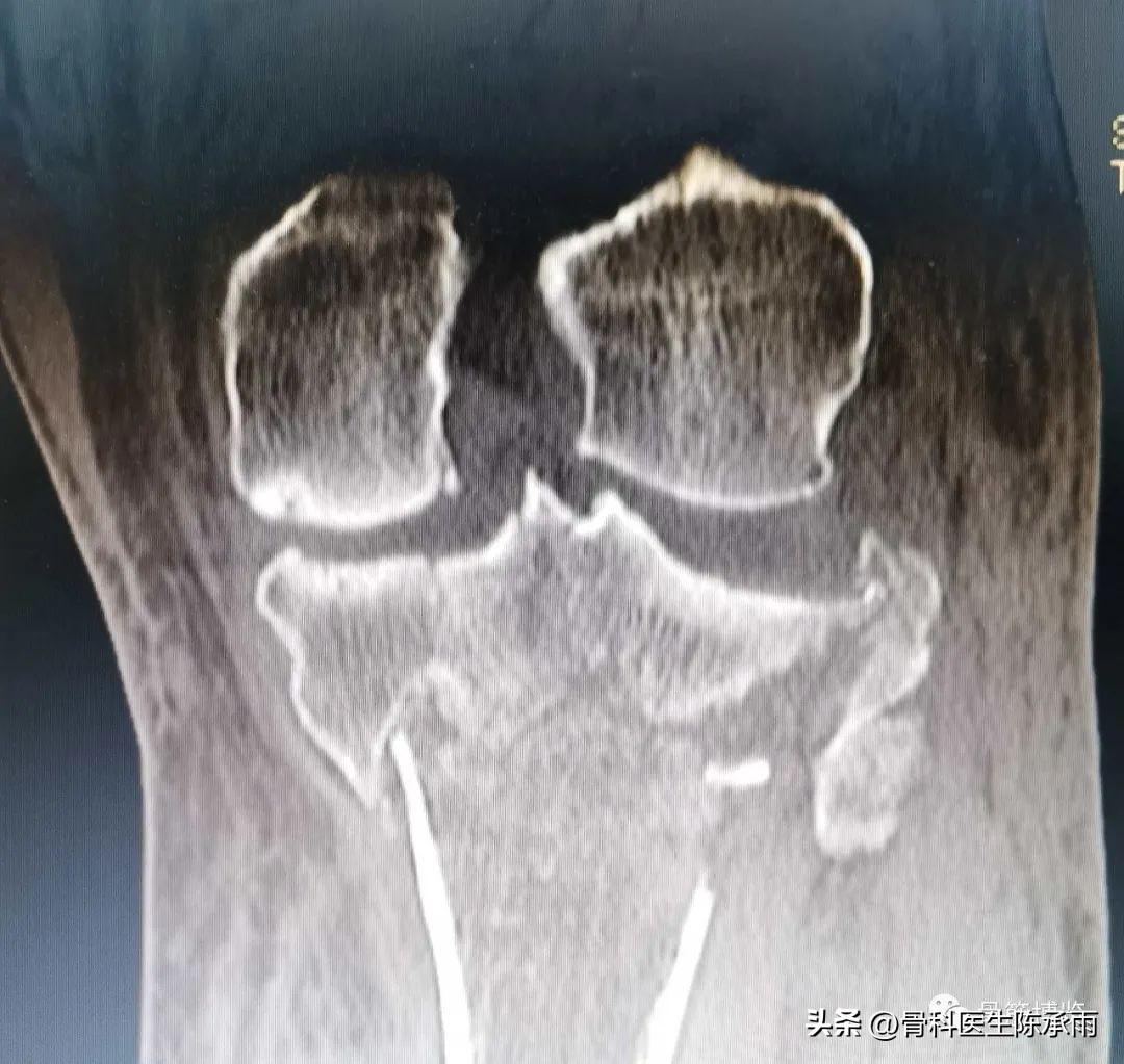 膝关节胫骨平台骨折,最近胫骨平台骨折视频