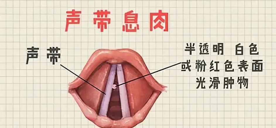 体检发现有息肉，离癌症还有多远？我彻底方了...