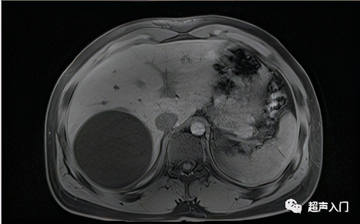 肝包虫病B超能检查出来吗?