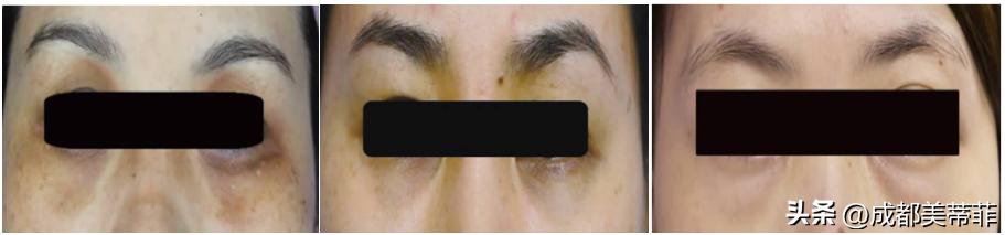 靠谱小妙招帮你解决黑眼圈问题,黑眼圈太重如何零成本消除黑眼圈