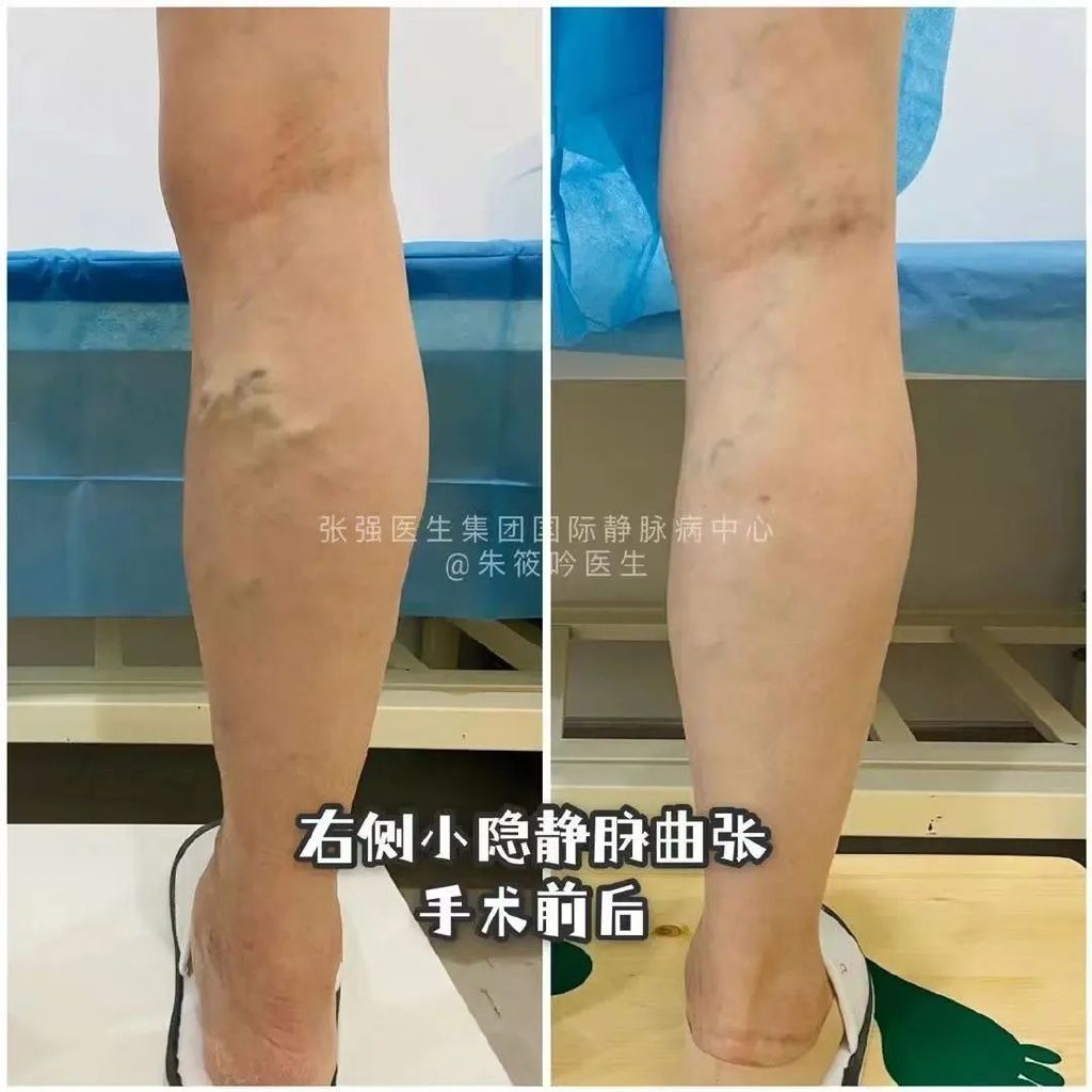 静脉曲张可以根治吗,静脉曲张能治好吗