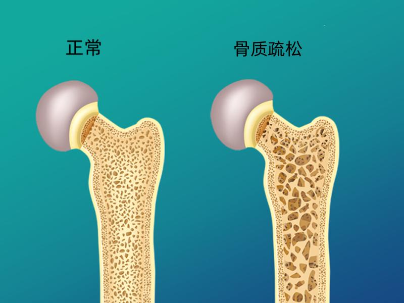 老年人骨质疏松和骨质增生的区别,老年人骨折容易引起什么疾病