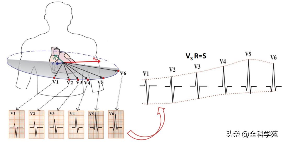 心电图qrs间期变长是怎样造成的,心电图qrs振幅多少是正常范围