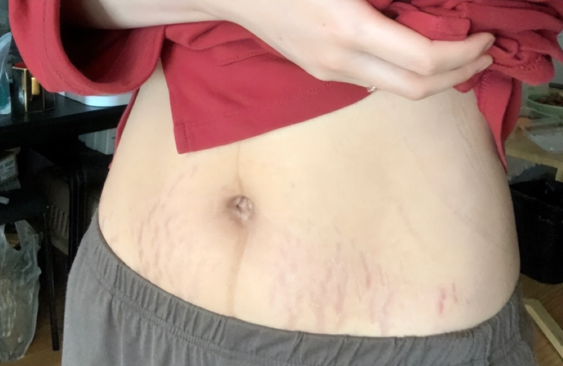 怀孕期间淡化妊娠纹的产品推荐,妊娠纹有没有好用有效果的产品