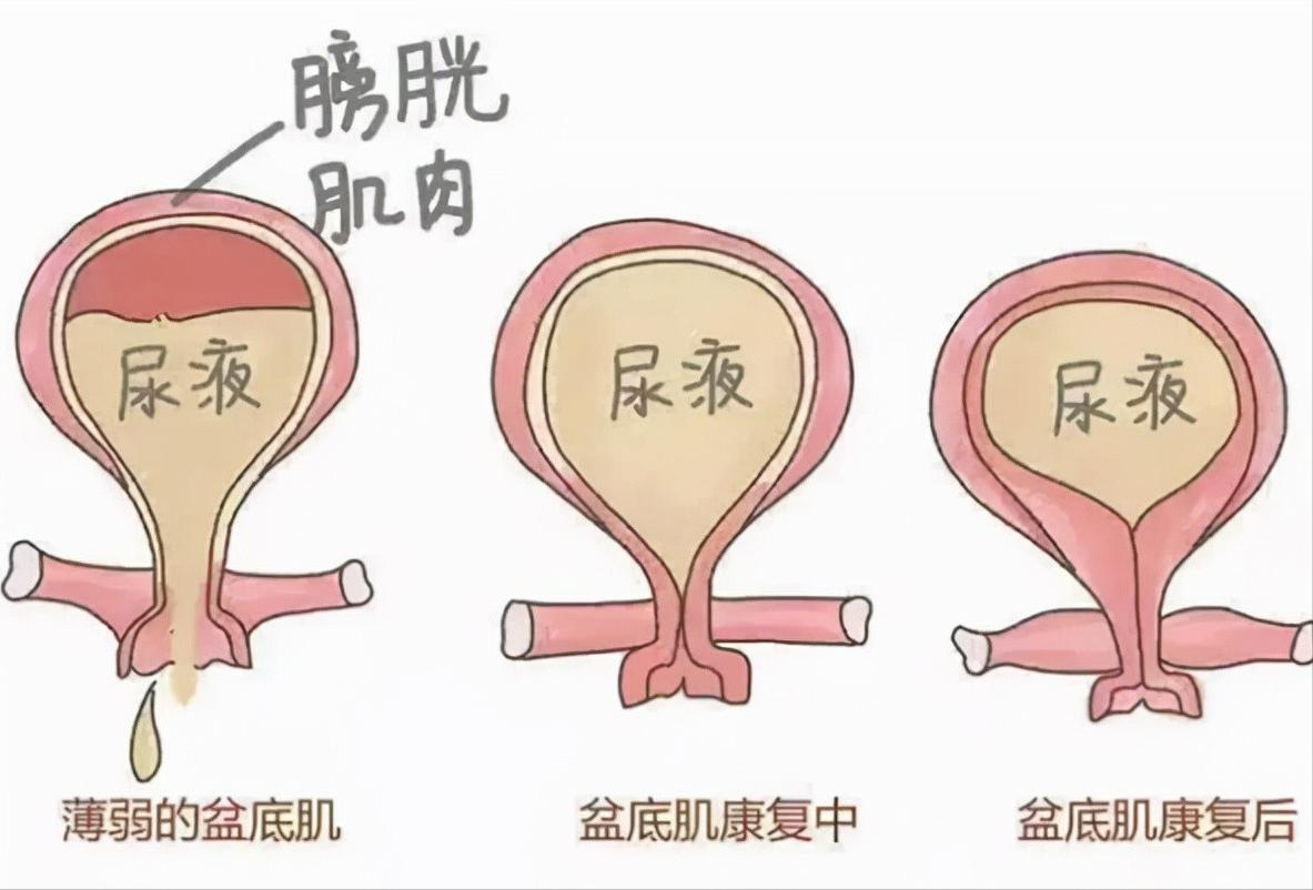 凯格尔修复盆底肌漏尿的最快方法,产后漏尿修复盆底肌简单动作视频