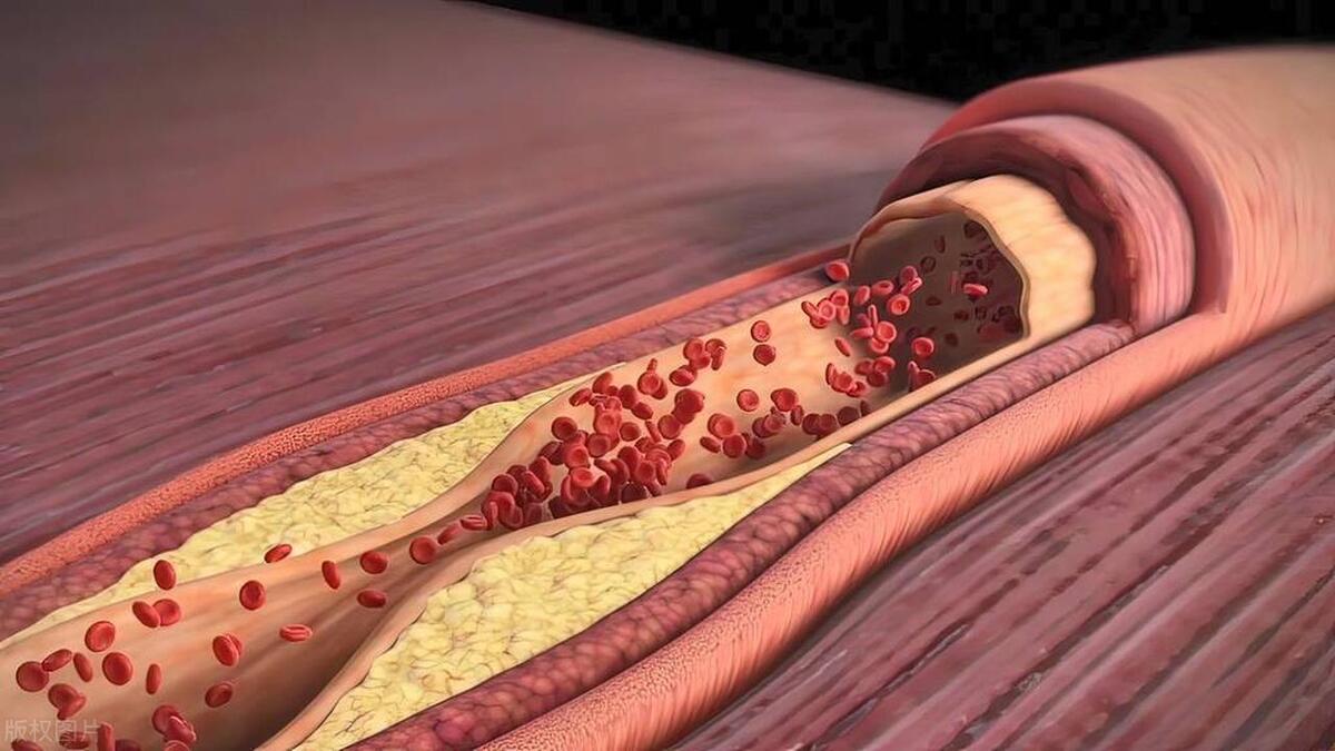 冠心病能乱停药吗?提醒:给您讲讲这5种常备药,作用是什么