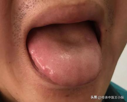 寒热舌诊图解大全,如何看舌象判断疾病准确用药