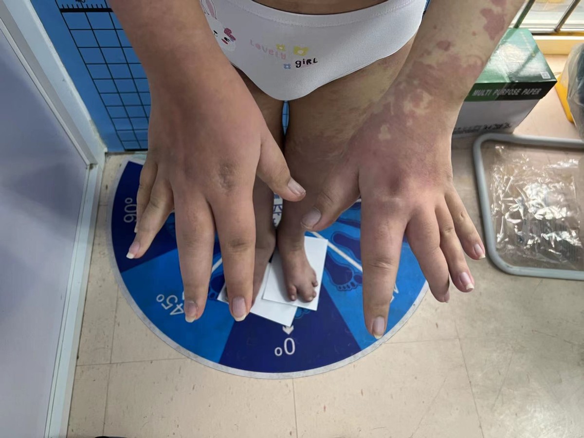 14岁女孩PROS综合症伴月经出血不止介入治疗病例