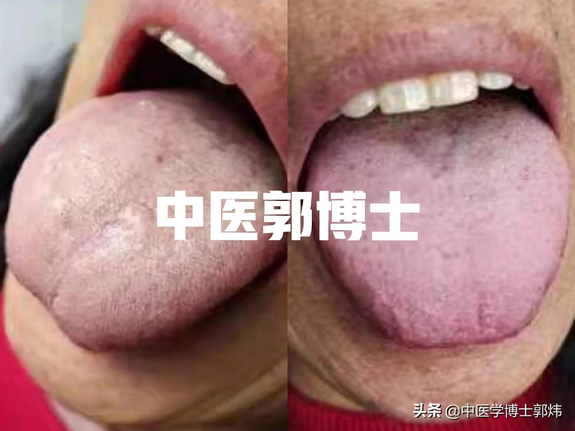 慢性胃炎腹胀打嗝吃什么药效果好,萎缩性胃炎打嗝吃什么中成药好