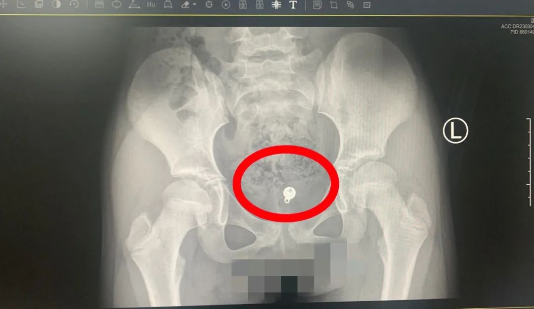 【警惕】10岁女童*体下**渗液5年，医生竟从私密处取出金属球