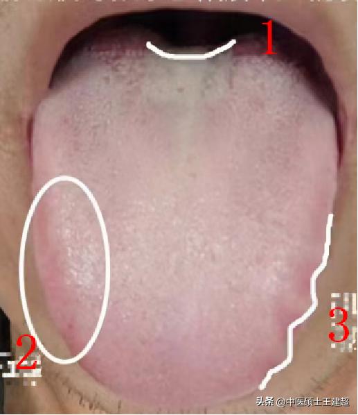 湿热下注到下肢吃什么中成药,湿热下注首先祛脾胃湿热