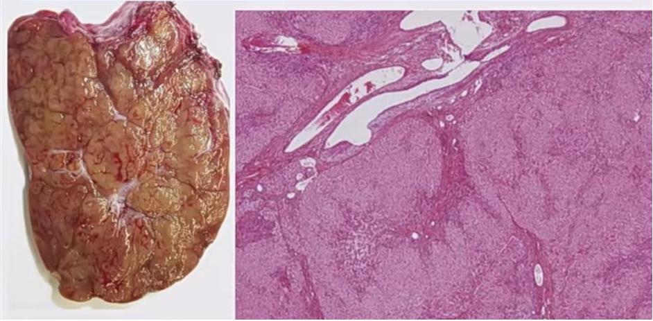 肝囊肿和肝占位影像学鉴别,杨永峰医生个人简历
