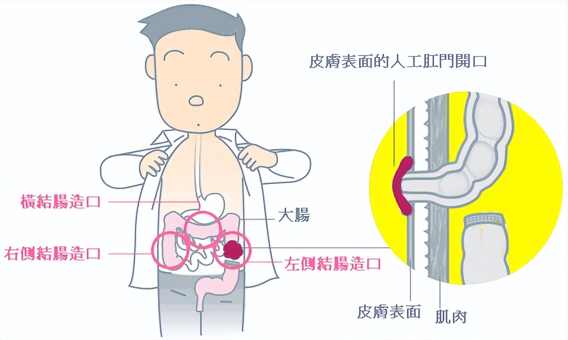 造口人术后怎么护理,造口患者日常生活护理宣教