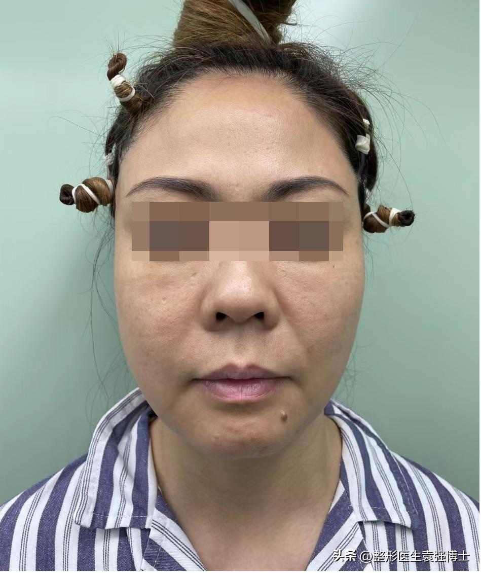 大拉皮多久可以修复大小脸,面部整体轻微松弛可以做大拉皮吗