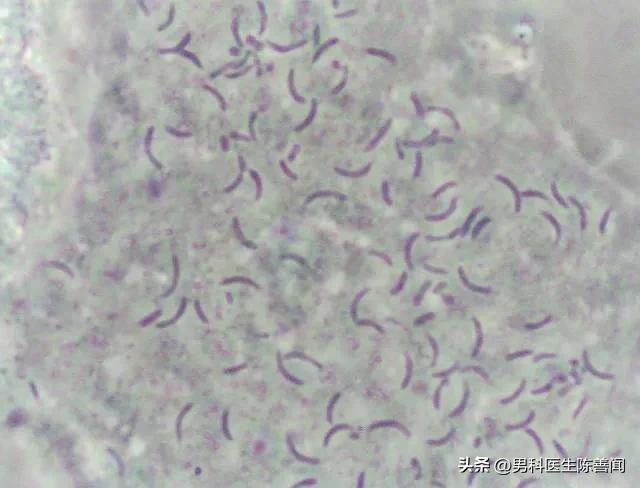 男人得滴虫病是什么症状,滴虫病是男人先得还是女人先得