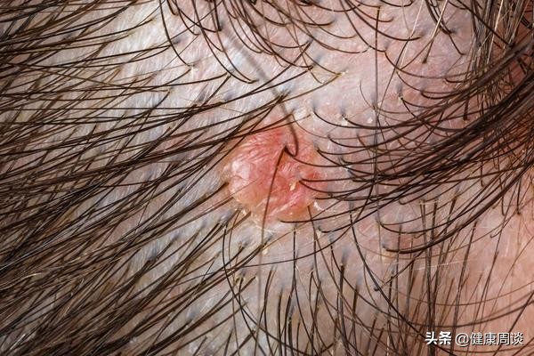 头皮痒有小疙瘩中医,头皮发痒头屑多医生建议
