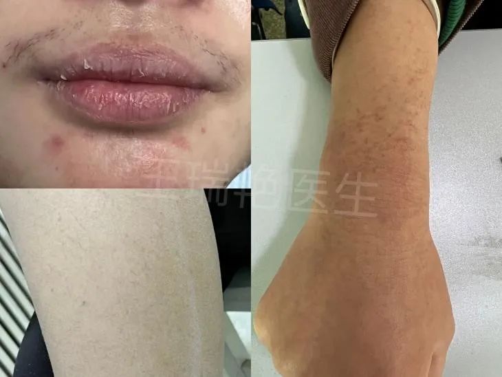 男生吃异维a酸有副作用吗,童诺异维a酸红霉素副作用